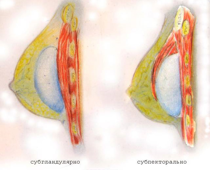 схема распложения грудных имплантатов