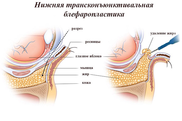 схема зон избыточного отложения подкожно-жировой клетчатки