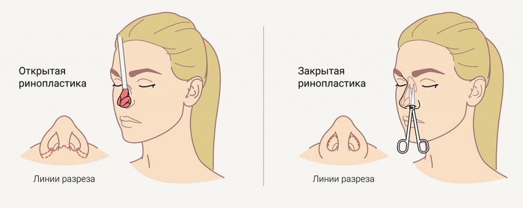 отличия закрытой и открытой ринопластик