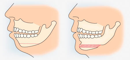 схема проведения пластики подбородка