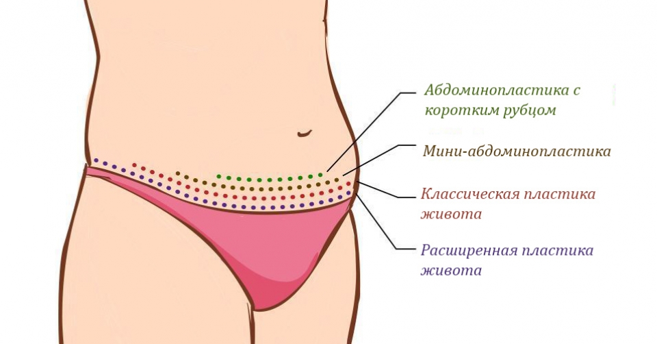 виды пластики живота