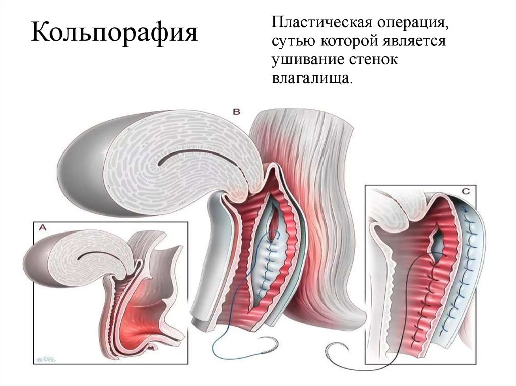 ушивание стенок влагалища - кольпорафия