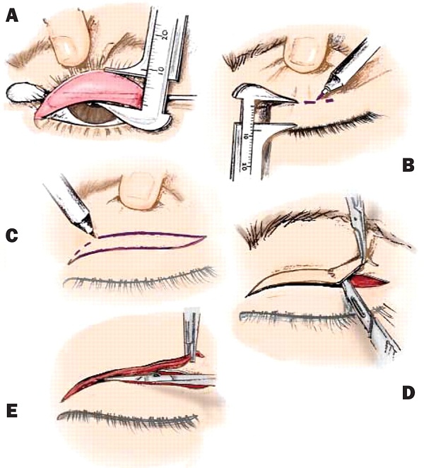 схема азиатской блефаропластики