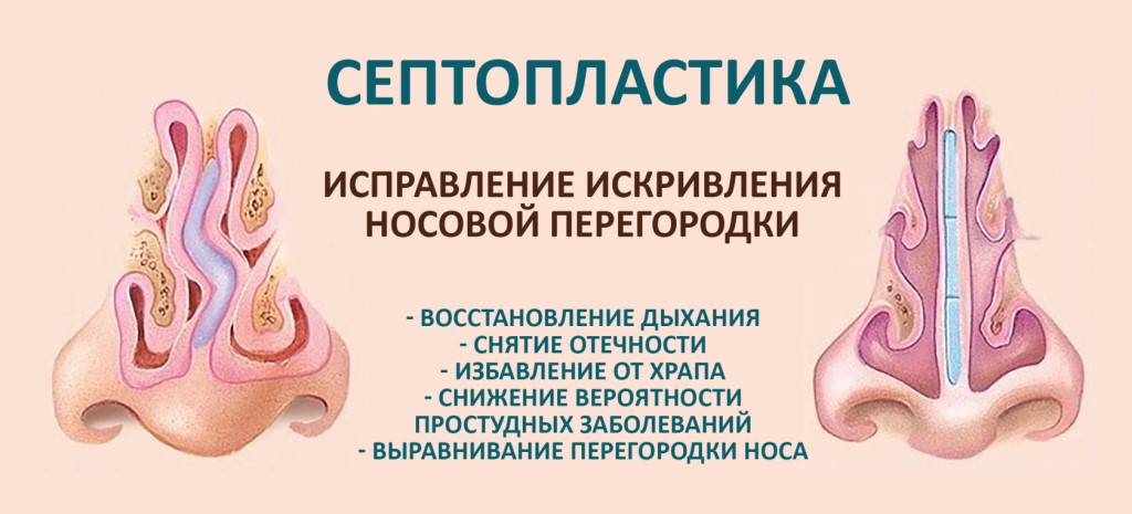 показания к исправлению носовой перегородки