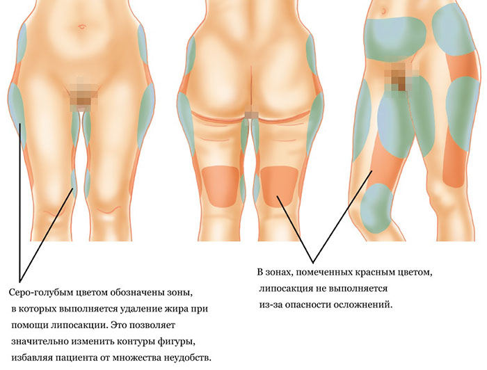 разрешенные и запрещенные участки проведения феморопластики