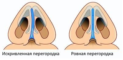 искривленная и прямая носовая перегородка