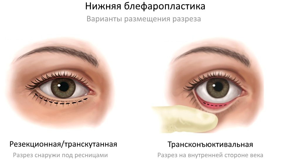 размещение разреза при трансконъюнктивальной пластике век