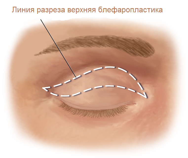 линия разреза при верхней блефаропластике