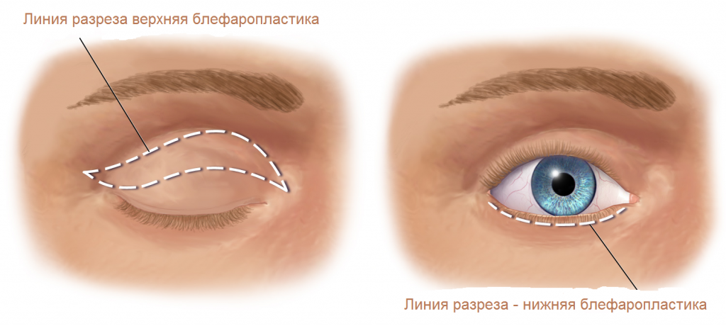 линии разреза при круговой блефаропластике