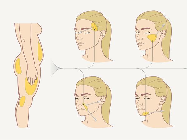 участки забора жирового материала на теле и места введения на лице