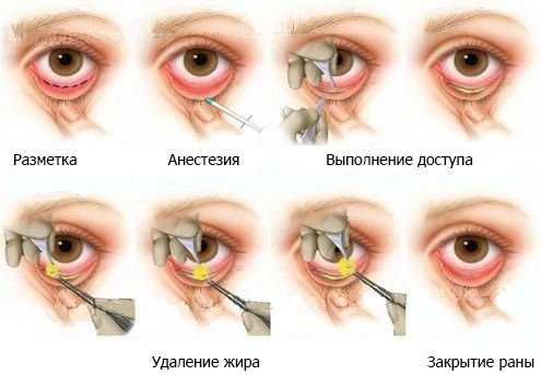 последовательность проведения пластики нижних век