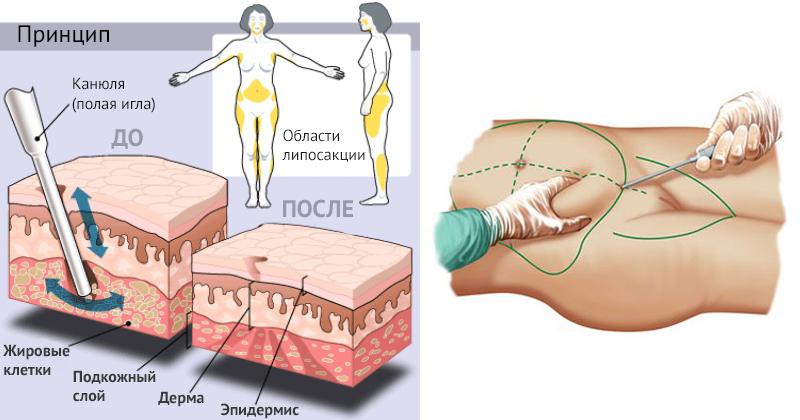 схема до и после проведения вибрационной липосакции