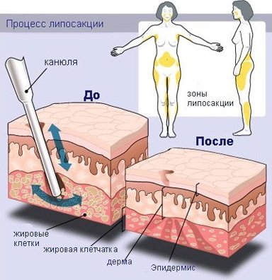 схема до/после липосакции области живота