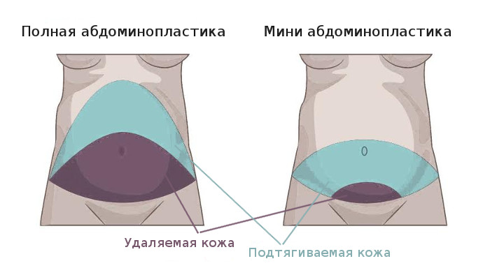 отличия полной абдоминопластики от мини