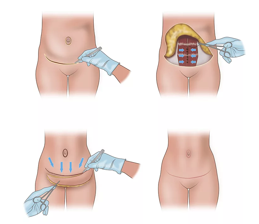 схема мини пластики живота