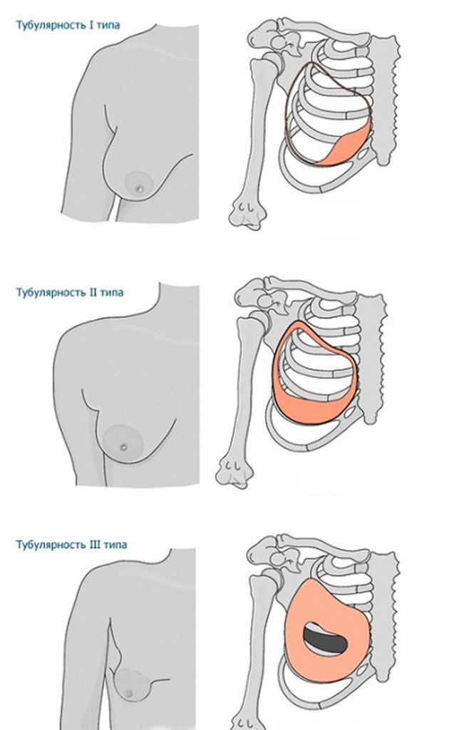 виды тубулярной груди