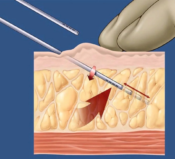 забор жировой ткани с помощью специальной канюли